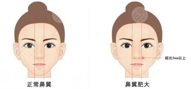 鼻頭鼻翼鼻尖整形的注意事項(xiàng)