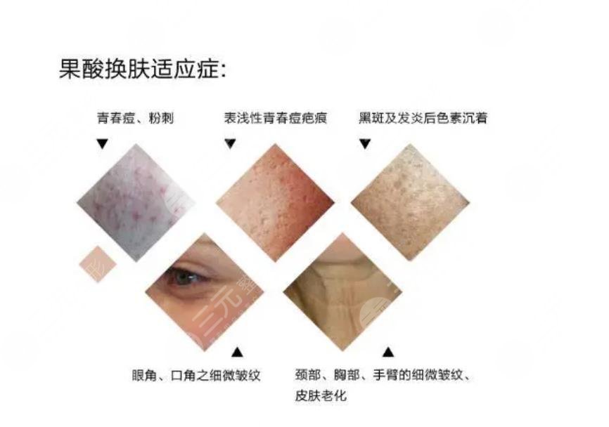 果酸換膚費用大概?多少?