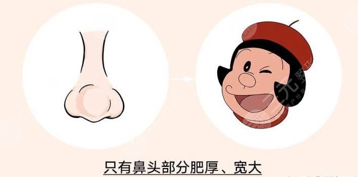 　　蒜頭鼻整形前后對(duì)比，小編通過調(diào)查了解到，有許多小伙伴正在飽受蒜頭鼻帶來的不好的影響，蒜頭鼻又被稱為大鼻頭，無論男生還是女生，一旦長成蒜頭鼻，就會(huì)讓整個(gè)人看起來面部的不協(xié)調(diào)，影響美觀程度，而且如果鼻頭很大的話，咱們看這個(gè)人的大部分眼光就會(huì)集中在鼻頭，并且忽略面部其他地方。除此之外，蒜頭鼻的小伙伴們?cè)诨瘖y的時(shí)候也會(huì)感到特別煩惱。所以有一些小伙伴會(huì)去做蒜頭鼻整形手術(shù)，收獲一個(gè)小巧好看的鼻頭。  　　一、蒜頭鼻整形手術(shù)原理  　　蒜頭鼻的形成原因是因?yàn)楸穷^部分的脂肪組織比較厚，鼻翼的軟骨發(fā)育過度或者鼻翼軟骨發(fā)育過程中往后縮，從而造成了蒜頭鼻。在進(jìn)行蒜頭鼻矯正手術(shù)的過程當(dāng)中，醫(yī)生是通過切除鼻子部分多余的軟骨和脂肪組織，然后將鼻頭聚攏縫合，在傷口愈合過后，就可以收獲一個(gè)又細(xì)又直的小巧好看的鼻子。這類手術(shù)的切口微小，傷口不，愈合過后也不容易看出切口的痕跡，愛美的小伙伴可以詳細(xì)去了解蒜頭鼻整形手術(shù)，判斷自己的鼻頭形狀，再進(jìn)行手術(shù)改良。  　　二、蒜頭鼻的分類  　　首先咱們的鼻翼軟骨發(fā)育過度會(huì)導(dǎo)致蒜頭鼻，這樣的蒜頭鼻整個(gè)人的鼻頭看起來又大又大，的不好看，但是改良的方法是比較簡單的，可以直接將發(fā)育過度的鼻翼軟骨切除掉，或者可以將鼻翼軟骨聚攏再縫合，也能達(dá)到收縮鼻翼的果。其次是鼻頭的軟組織肥厚，造成的蒜頭鼻，這種蒜頭鼻的特征是，起來肉乎乎的軟綿綿的。  　　要進(jìn)行手術(shù)調(diào)整的話，就需要切除鼻子的部分軟組織，這種改良手術(shù)考驗(yàn)醫(yī)生的手術(shù)技術(shù)，如果醫(yī)生在手術(shù)過程當(dāng)中操作不當(dāng)?shù)脑?，就很可能?huì)導(dǎo)致鼻頭的軟組織增生，會(huì)讓鼻頭越來越大，變成大蒜頭鼻。后就是鼻尖很矮，就會(huì)顯得鼻頭很塌，這類蒜頭鼻就不需要切除鼻部組織，可以通過抬高鼻尖來達(dá)到縮小鼻翼的果，這類改良方式是相對(duì)來說簡單的。  　　三、蒜頭鼻整形前后對(duì)比  　　小編的大學(xué)室友就是一個(gè)典型的蒜頭鼻女孩，不看鼻頭的話，她皮膚白皙有光澤，眼睛大雙眼皮嘴巴小巧，臉型也是標(biāo)準(zhǔn)的鵝蛋臉，看起來的好看，但是美中不足的是，她的鼻頭看起來的大，肉嘟嘟的，也就顯得她的山根很低，這就使得她的顏值降低了百分之五十，特別是嘴巴小巧就更顯得鼻頭大，整個(gè)人看起來就不再精致，顯得比較憨厚老實(shí)。前段時(shí)間，她在朋友的推薦下，準(zhǔn)備通過整形手術(shù)來改良自己的蒜頭鼻。  　　她講述到，她去到了整形醫(yī)院，整形醫(yī)生根據(jù)她的鼻頭設(shè)計(jì)了切除鼻部多余軟組織的手術(shù)方案。醫(yī)院安排了一位臨床經(jīng)驗(yàn)豐富的整形醫(yī)生，為她進(jìn)行了切除鼻部軟組織的手術(shù)。術(shù)后一周左右，她發(fā)現(xiàn)自己的鼻頭沒有腫脹感了，整體的恢復(fù)也比較快，她自己也感覺到鼻頭的縮小了。  　　術(shù)后一個(gè)月左右，她的鼻子已經(jīng)變得的好看，因?yàn)槿馊獾谋穷^被切除縮小了，也就讓她的山根顯得高挺起來，鼻頭變得小巧精致，整個(gè)人的顏值大大的提升，從一個(gè)面相憨厚的女生變成了大美女。她本人也變得更加自信，以前拍照只敢露半張臉的她，現(xiàn)在拍照能夠大大方方露全臉，不用再因?yàn)樽约旱乃忸^鼻被家人朋友嘲笑了。  　　小編希望所有和我大學(xué)室友有相同困擾的小伙伴，可以勇敢的面對(duì)自己的蒜頭鼻，自信的走進(jìn)整形醫(yī)院，做一場適合自己的蒜頭鼻整形手術(shù)，從根本上改良自己的顏值，讓自己也能在自己的生活圈里面自信放光芒。
