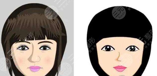 蒜頭鼻整形前后對(duì)比