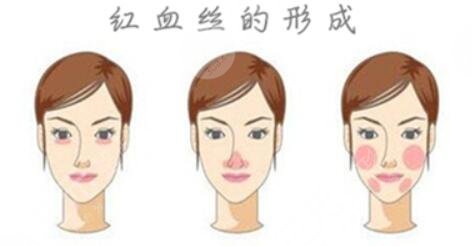 臉上為什么會(huì)出現(xiàn)紅血絲?