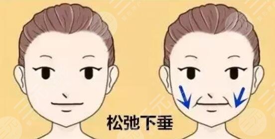 面部下垂提升術(shù)多少錢？具體術(shù)式、操作方案及步驟、預(yù)期果點擊了解！