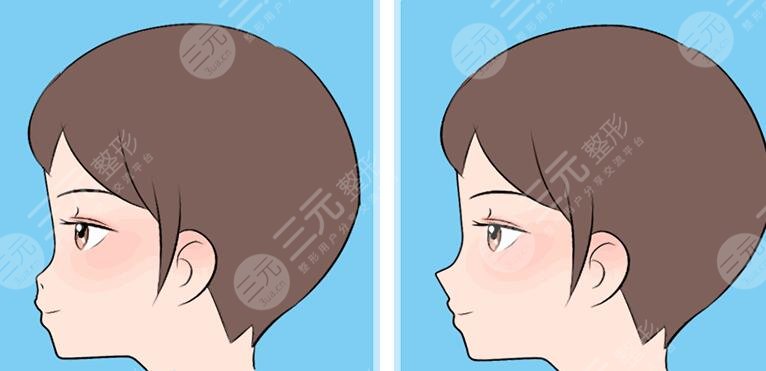 鼻子整形前后對比圖