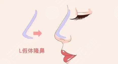 鼻子整形前后對比圖