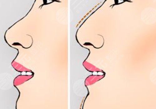 重慶華美做鼻子怎么樣？