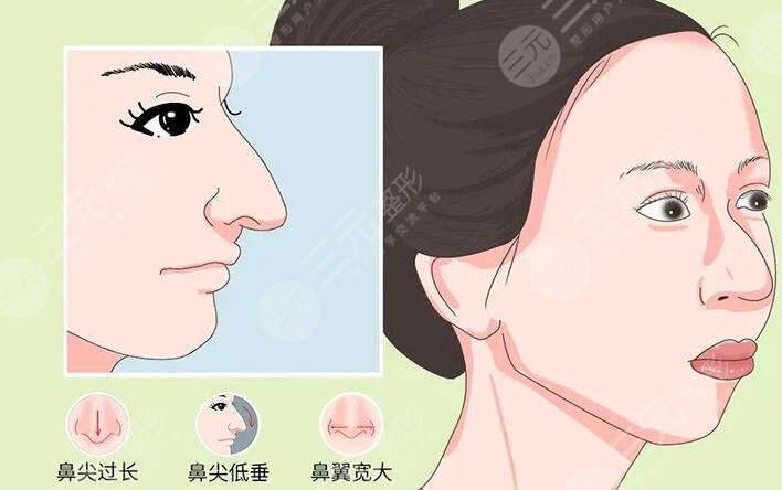 鷹鉤鼻整容整形手術(shù)多少錢2023同步更新！術(shù)前準(zhǔn)備及術(shù)后注意事項牢記于心！