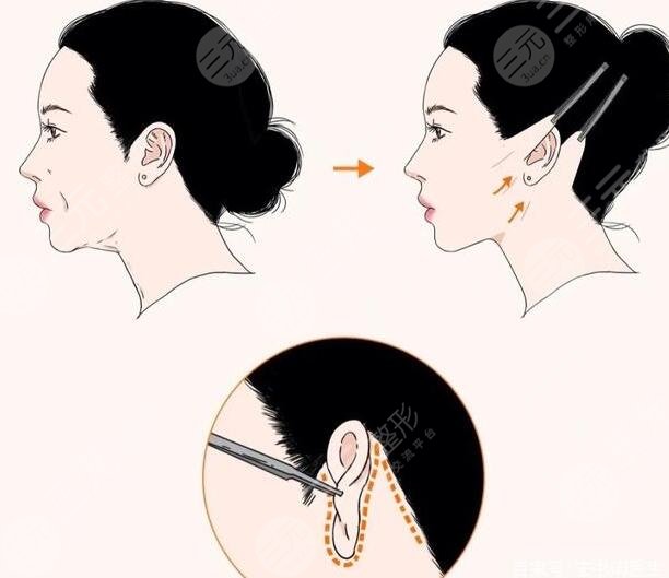 小切口拉皮除皺術(shù)價(jià)格多少？