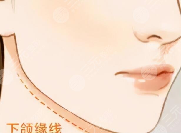 下頜角磨骨手術(shù)適合人群