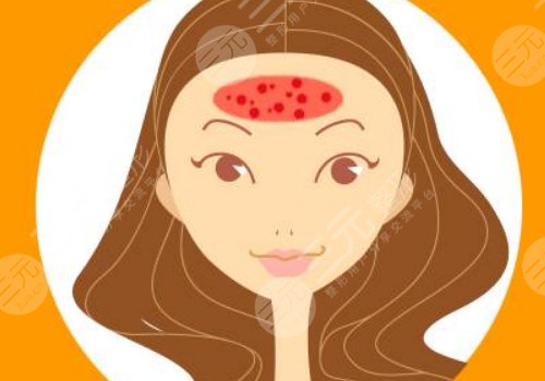 額頭長(zhǎng)了很多密密麻麻的小痘痘是什么原因？