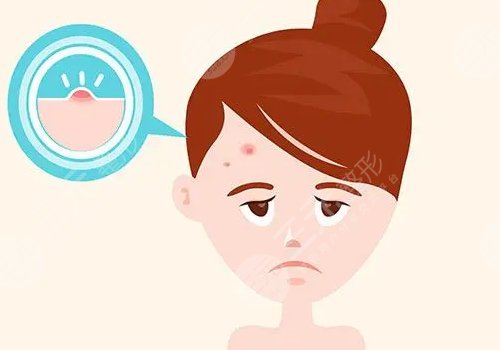 額頭長(zhǎng)了很多密密麻麻的小痘痘是什么原因？