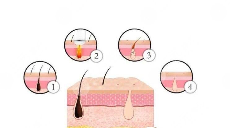 shr冰點脫毛價格是多少?