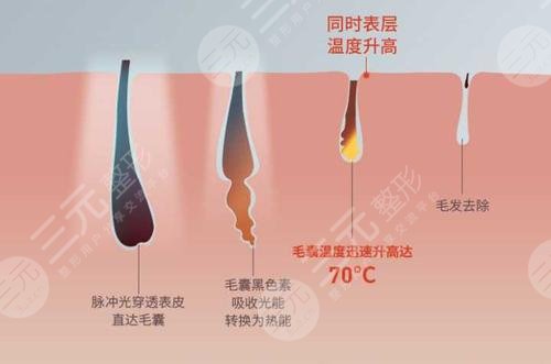 光子脫毛需要做幾次?