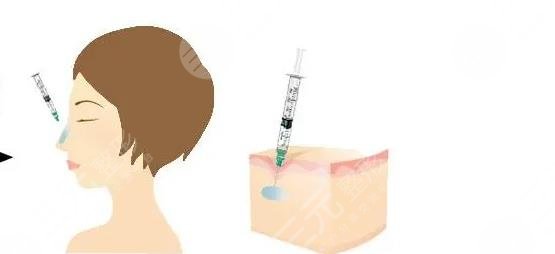 打玻尿酸有什么作用?