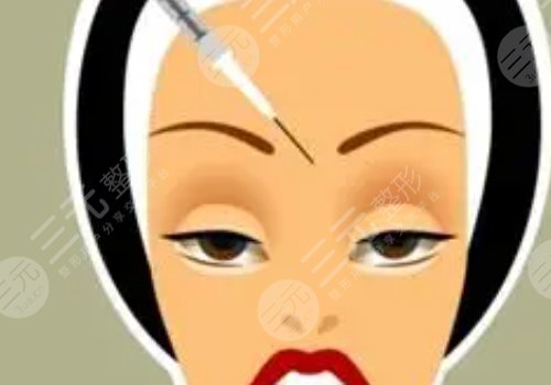 瑞蘭2號玻尿酸適合打哪里?