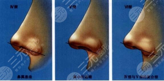 鼻尖整形多久可以恢復(fù)呢?