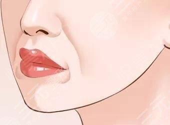 玻尿酸去法令紋需?要多少錢(qián)?