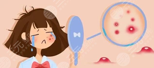 光動力激光緩解痤瘡多少錢?