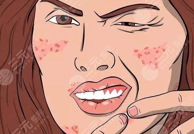 光動力激光緩解痤瘡需要做好哪些護理?