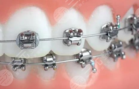 牙齒矯正