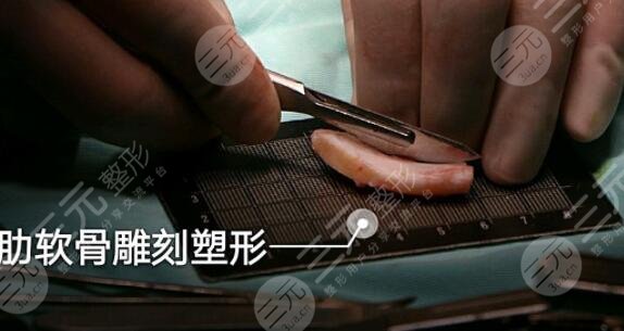 自體軟骨隆鼻價(jià)格的影響因素有哪些?