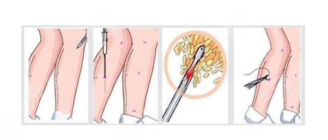 減小腿的方法有哪些?