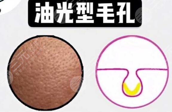 男性毛孔粗大怎么辦?