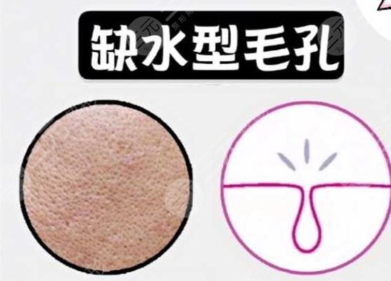 男性毛孔粗大怎么辦?