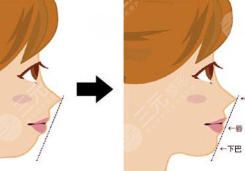 北大深圳醫(yī)院隆鼻多少錢?