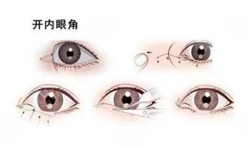 影響開內(nèi)眼角手術(shù)價(jià)格的因素有哪些?