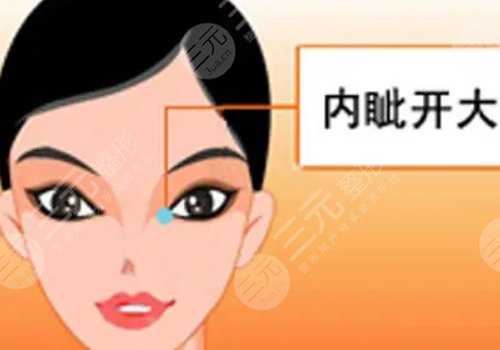 影響開內(nèi)眼角手術(shù)價(jià)格的因素有哪些?