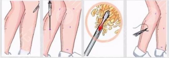 小腿吸脂術(shù)效果好嗎？