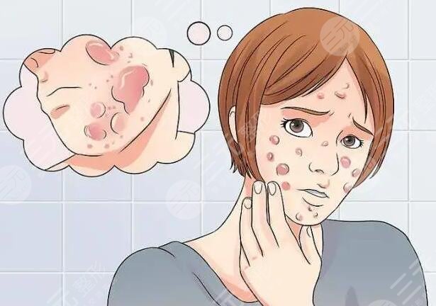 緩解痤瘡的注意事項(xiàng)