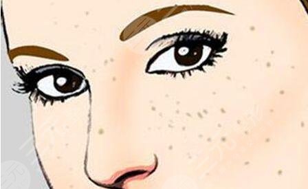 彩光祛斑是什么原理?