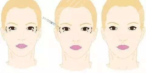 眼部細(xì)紋的形成原因