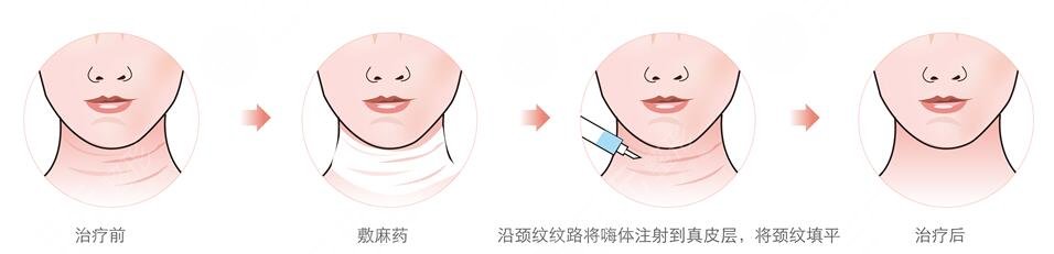 消除雙下巴與頸紋的注意事項