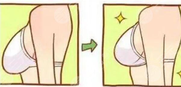 乳房懸吊術(shù)會留疤嗎？疤痕嗎？一般在哪個位置？手術(shù)效果可以維持多久？