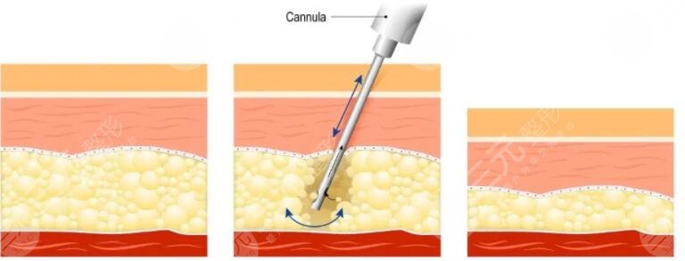 吸脂減肥的優(yōu)點