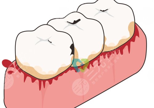 牙齒松動(dòng)有什么辦法恢復(fù)?