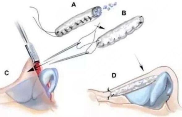 隆鼻需要多長時間恢復(fù)?