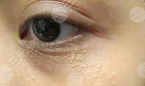 眼部脂肪粒如何去除小妙招?