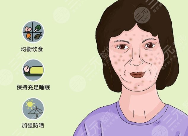 激光緩解黃褐斑原理是什么?