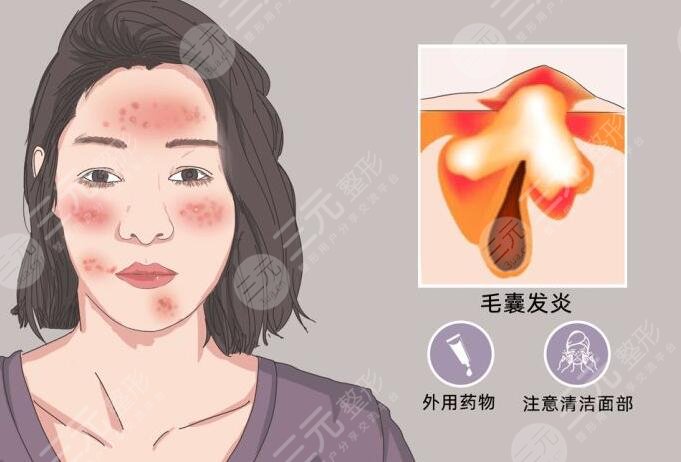 如何快速去青春痘?