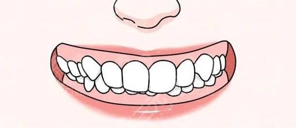 深覆合一定要做矯正嗎？深覆合矯正前后臉型對(duì)比圖|合適的年紀(jì)是多久？