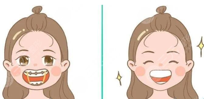 深覆合的矯正年齡是多少?