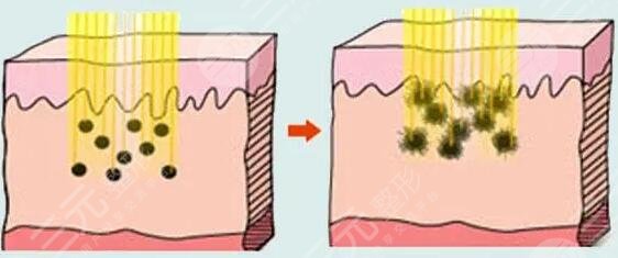 點(diǎn)陣激光緩解痘坑會反彈復(fù)發(fā)嗎?