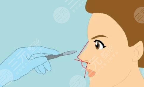 蒜頭鼻怎么變??？