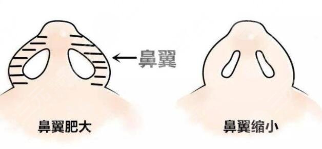 蒜頭鼻縮小整形手術(shù)可以維持多長(zhǎng)時(shí)間?