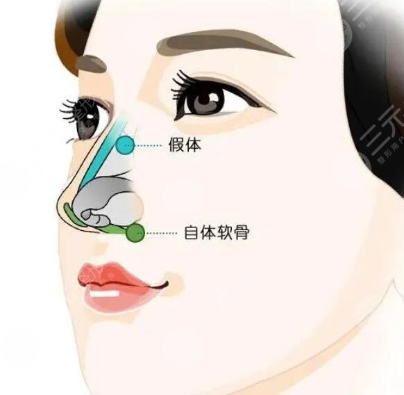 膨體材料隆鼻多少錢2023新版，手術(shù)材料的優(yōu)缺點(diǎn)解析、術(shù)后護(hù)理小貼士~