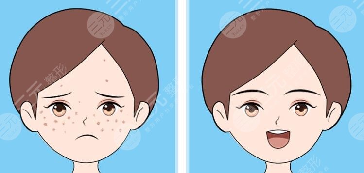 2023年彩光祛斑費(fèi)用是多少?