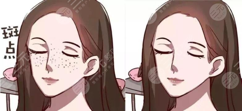 激光祛斑原理是什么?